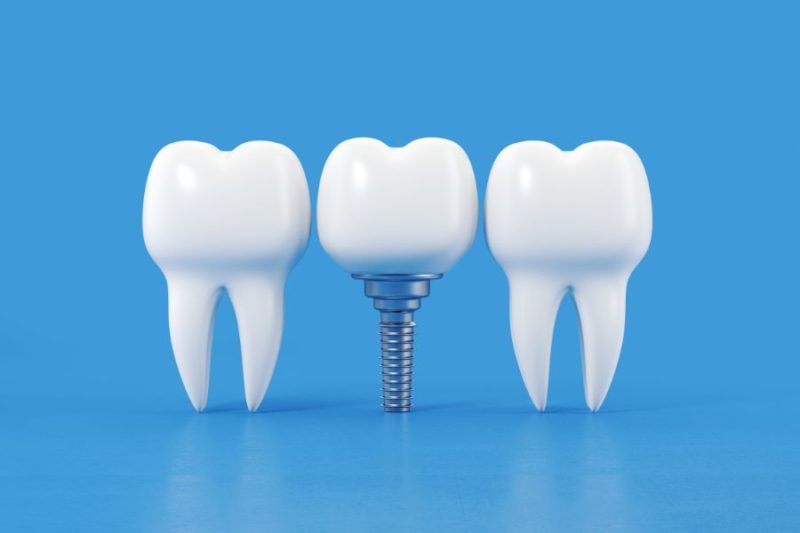 En la fotografía se pueden ver diferentes implantes dentales.